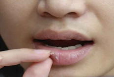 8 Cara Mengatasi Bibir Kering yang Ampuh dan Cepat